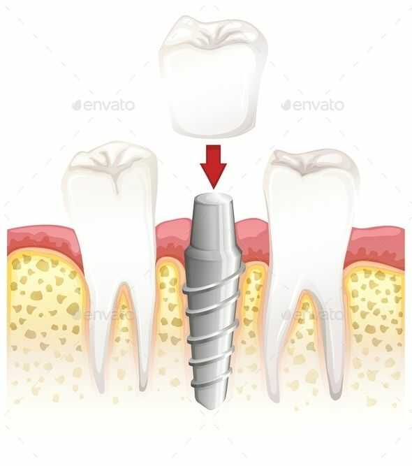 image that symbolize dentistry implants